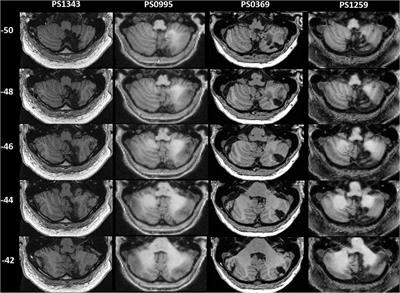 The Effect of Focal Damage to the Right Medial Posterior Cerebellum on Word and Sentence Comprehension and Production